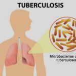 Tuberkulosis : Penyakit Mematikan yang Masih Menghantui Indonesia