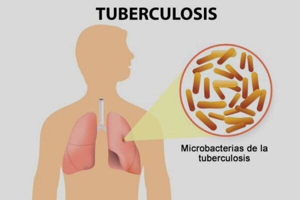 Tuberkulosis : Penyakit Mematikan yang Masih Menghantui Indonesia